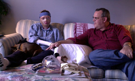 Learning to deal with the burns and injuries with her husband